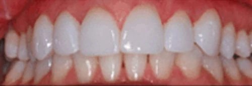 After porcelain veneers at Lamb Family Dental