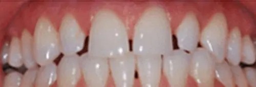 Before porcelain veneers at Lamb Family Dental Boise