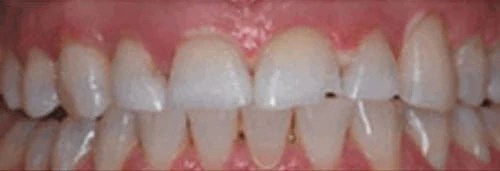 After in-house whitening at Lamb Family Dental