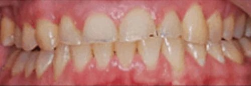 Before in-house whitening at Lamb Family Dental Boise