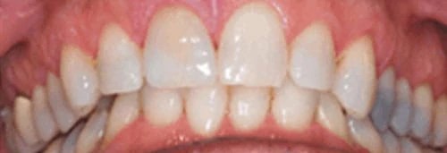 Before broken anterior crown repair at Lamb Family Dental Boise