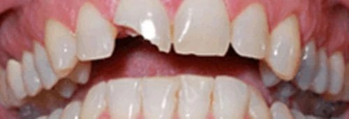 After broken anterior crown repair at Lamb Family Dental