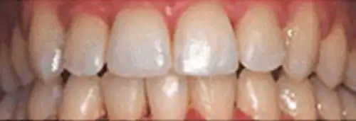 After Invisalign at Lamb Family Dental Boise