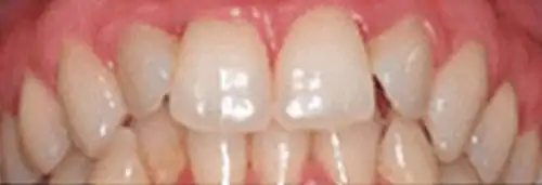 Before Invisalign at Lamb Family Dental Boise