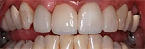 After 4 crowns at Lamb Family Dental Boise