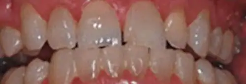 Before anterior bonding at Lamb Family Dental Boise