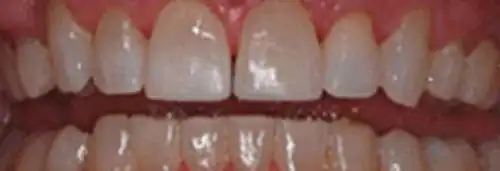 After anterior bonding at Lamb Family Dental Boise