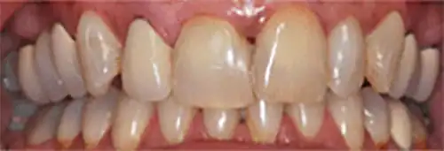 Before 4 crowns at Lamb Family Dental Boise