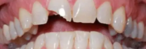 After broken anterior crown at Lamb Family Dental Boise