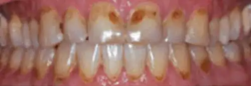 Before maxillary re-conditioning at Lamb Family Dental Boise