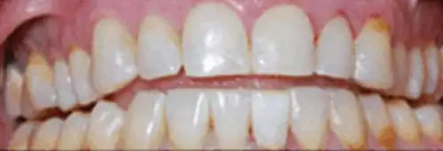 After maxillary re-conditioning at Lamb Family Dental Boise