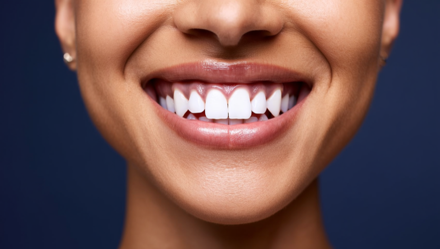 Professional teeth whitening treatment at Lamb Family Dental in Boise, Idaho