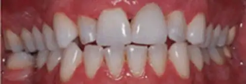 After implant placement & anterior bonding at Lamb Family Dental Boise