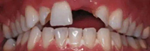 Before implant placement & anterior bonding at Lamb Family Dental Boise
