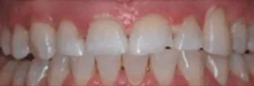 After in-house whitening at Lamb Family Dental Boise