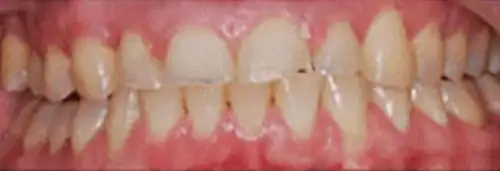 Before in-house whitening at Lamb Family Dental Boise