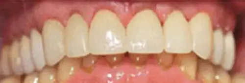 After max arch crown at Lamb Family Dental Boise