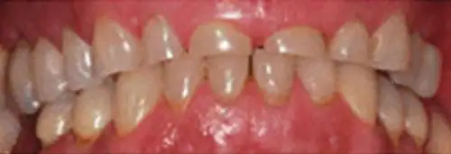 Before max arch crown at Lamb Family Dental Boise