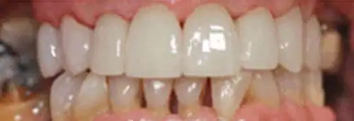 After maxillary crowns at Lamb Family Dental Boise
