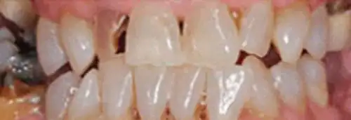Before maxillary crowns at Lamb Family Dental Boise