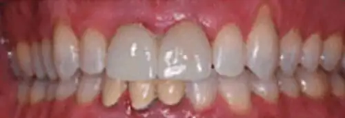 After crown case replacement at Lamb Family Dental Boise