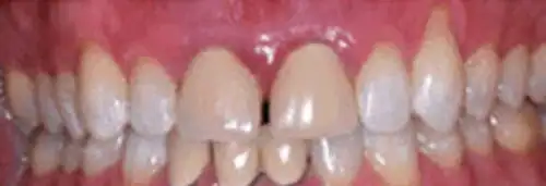 Before crown case replacement at Lamb Family Dental Boise