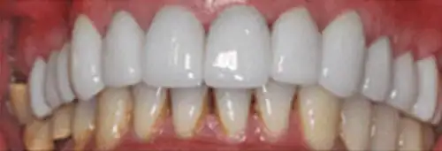 After maxillary re-conditioning at Lamb Family Dental Boise