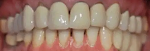 Before maxillary re-conditioning at Lamb Family Dental Boise