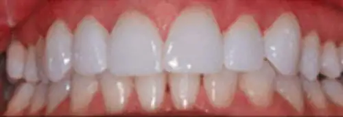 After veneers at Lamb Family Dental Boise