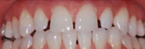 Before veneers at Lamb Family Dental Boise